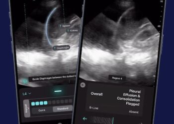 FDA Approval: AI-Driven Ultrasound Revolutionizes Pleural Effusion Detection